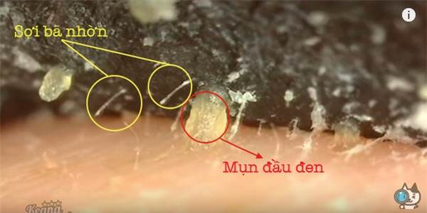 Mụn đầu đen Mụn đầu đen
