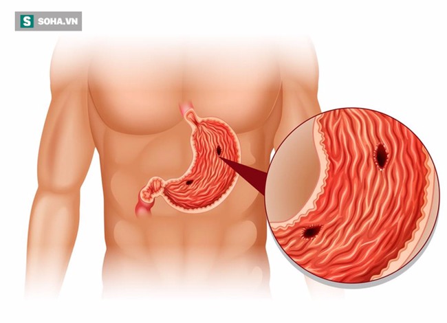 Suýt thủng dạ dày vì chữa bệnh bằng tinh nghệ: BS cảnh báo sai lầm trong trị bệnh dạ dày - Ảnh 2.