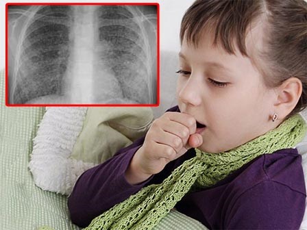 Trẻ vào viện vì viêm hô hấp, vài giờ sau phổi đã trắng xóa vì kháng sinh 