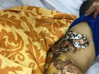 Bé trai 4 tuổi hoại tử da vì đắp lá thầy lang chữa bỏng