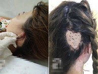 Chị em đi làm tóc cuối năm hãy cẩn thận: đã có người bị lột da đầu, người suýt mất tai