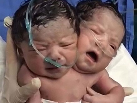 Video: Cặp song sinh liền thân khóc òa sau khi lọt lòng mẹ
