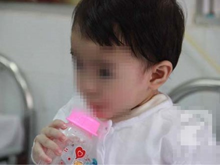 Bị muỗng đâm vào họng lúc ở nhà trẻ, bé gái 1 tuổi thủng thực quản nguy kịch