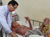 Nổ biến áp ở Sài Gòn, 2 nhân viên điện lực bỏng nặng