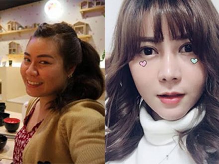 Sang Hàn Quốc thẩm mỹ, sau một tháng cô gái nhận được kết quả hết sức ngỡ ngàng