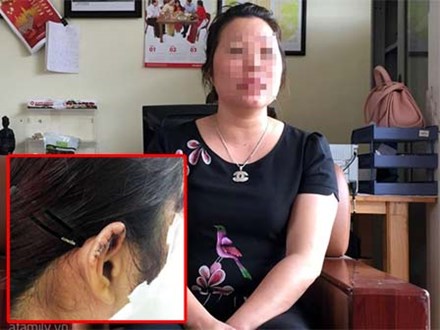 Vụ cắn đứt tai nữ giáo viên ở Hải Dương: Phụ huynh khẳng định cũng bị cô giáo cắn