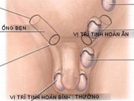 Nhiều trẻ biến thành “thái giám” vì bố mẹ chủ quan với bộ phận sinh dục của con