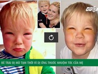 Bé trai 2 tuổi bị mù tạm thời vì mẹ nhuộm tóc 