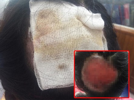 Tai nạn nghiêm trọng khi uốn tóc: Tóc cuốn vào ống dẫn nhiệt, nữ bác sĩ bỏng sâu, tróc gần toàn bộ da đầu phía sau