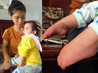 Xót thương bé gái hơn 1 tuổi bị côn trùng đốt khiến tay chân co quắp, teo não không thể nhận thức