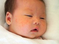 Trẻ sơ sinh nổi mẩn đỏ như muỗi đốt nên chăm sóc như thế nào?