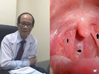 Chuyên gia đầu ngành tai mũi họng chỉ ra 6 'dấu hiệu chết' của ung thư vòm họng