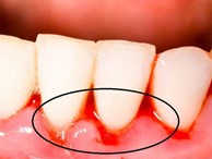 Đang đánh răng thấy chảy máu: Làm những điều sau để hết chảy máu chân răng