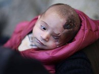 Syria: Xót thương bé 3 tháng tuổi chỉ còn một mắt