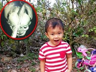  Bé trai bị đâm xuyên não khi mới 11 ngày tuổi đã đứng vững, đang “bi bô tập nói” và đón Tết thứ ba cùng cha mẹ 
