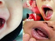 Phát hiện nốt nhỏ ở miệng hãy coi chừng trẻ đang mắc loại nấm nguy hiểm