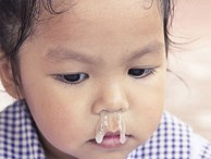 Các bác sĩ cảnh báo về cách chữa sổ mũi bằng tỏi ngâm nước muối sinh lý đang được các mẹ lan truyền
