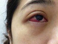  Cô gái bị tụ máu đỏ cả mắt do nhiễm trùng vì thói quen làm đẹp: Chị em hãy cẩn thận! 