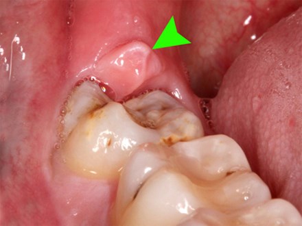 Răng số 8 có hay biến chứng? Khi nào biến chứng răng số 8 có thể gây tử vong?