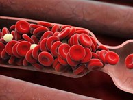 6 dấu hiệu cảnh báo cục máu đông: Nhiều người nhầm lẫn nên gặp nguy hiểm, thậm chí tử vong