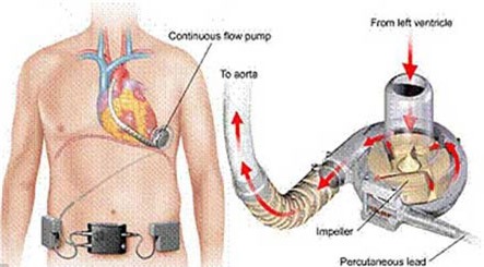 Thiếu nữ sống nhờ trái tim để trong túi xách 1