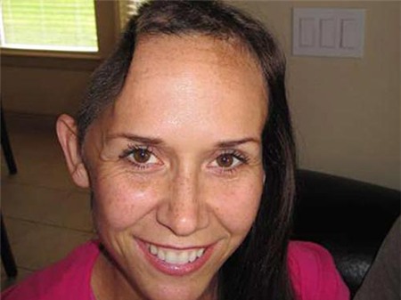 Những ca phẫu thuật cấy ghép không thể nào tin nổi 2