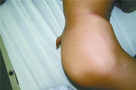 Chàng trai... mọc đuôi dài 5cm, Phi thường - kỳ quặc, chuyen la, chuyen la trung quoc, moc duoi, duoi thua, tin tuc