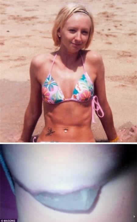 5 ca phẫu thuật “nhầm” tai hại, Phi thường - kỳ quặc, chuyen la, chuyen la phau thuat tham my, chuyen la the gioi, cay ghep nguc, cay ghep vong 3, tin tuc