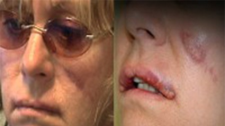 5 ca phẫu thuật “nhầm” tai hại, Phi thường - kỳ quặc, chuyen la, chuyen la phau thuat tham my, chuyen la the gioi, cay ghep nguc, cay ghep vong 3, tin tuc