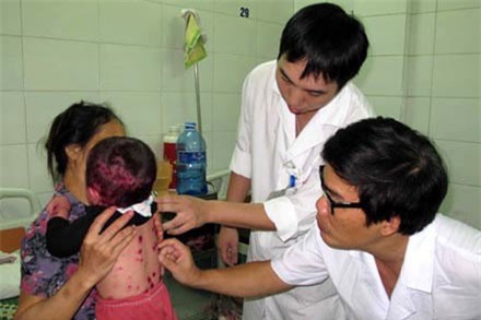 Đối phó với “mùa thủy đậu” của trẻ như thế nào? - 1