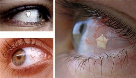 Xăm tròng mắt - Trào lưu làm đẹp kinh dị 1