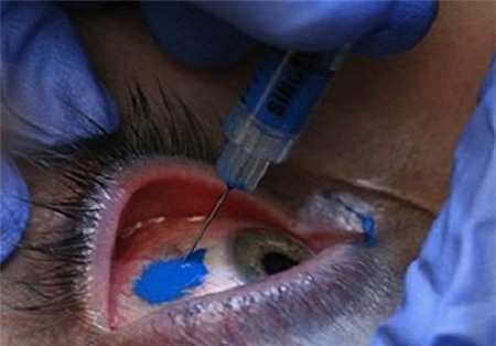 Xăm tròng mắt - Trào lưu làm đẹp kinh dị 3