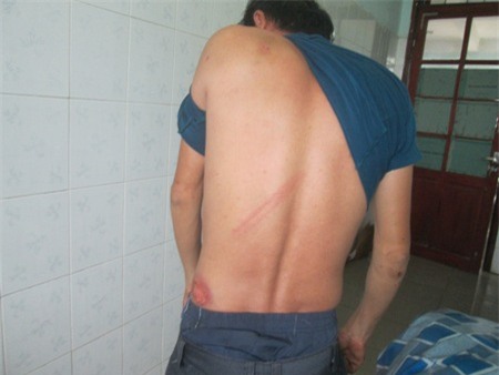 Anh Nguyễn Xuân Thủy bị đánh đang điều trị tại bệnh viện đa khoa huyện Kỳ Anh