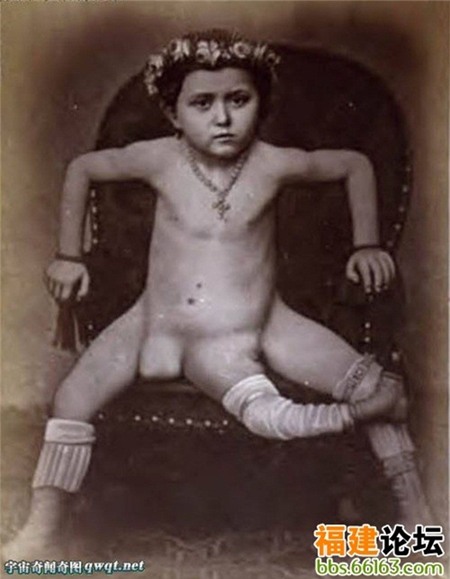 Người phụ nữ kỳ dị có 3 chân và 2 âm đạo riêng biệt