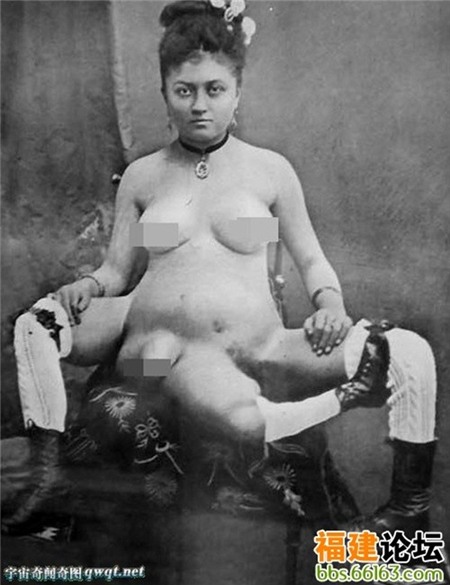 Người phụ nữ kỳ dị có 3 chân và 2 âm đạo riêng biệt