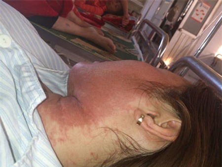 Mặt bỏng rộp vì dùng kem chống nắng mua trên mạng 1