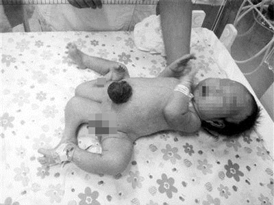 Kỳ lạ cậu bé có 4 chân, 2 bộ phận sinh dục 1
