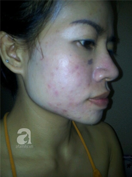Choáng khi dị ứng mỹ phẩm biến người thành