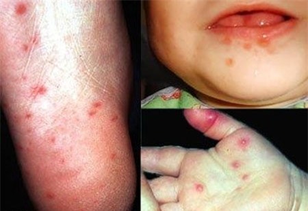 bệnh tay chân miệng, vắc-xin, enterovirus 71 (EV71), nhiễm trùng