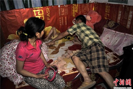 Cuộc sống đáng thương của cô bé 6 tuổi bị bỏng toàn thân 3