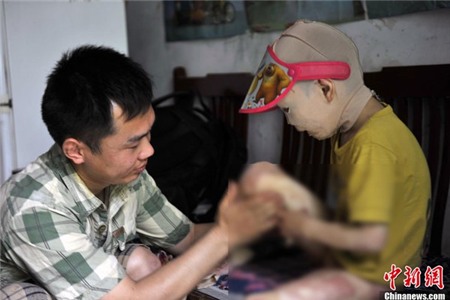 Cuộc sống đáng thương của cô bé 6 tuổi bị bỏng toàn thân 7