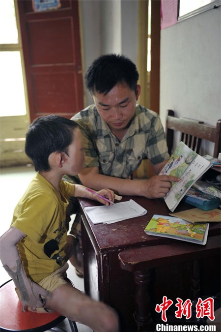 Cuộc sống đáng thương của cô bé 6 tuổi bị bỏng toàn thân 8