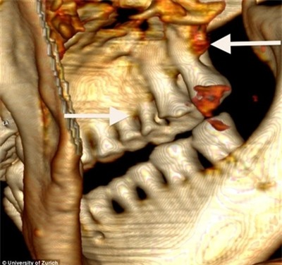 người băng, 5.300 năm, Otzi, phát hiện, răng, tế bào máu