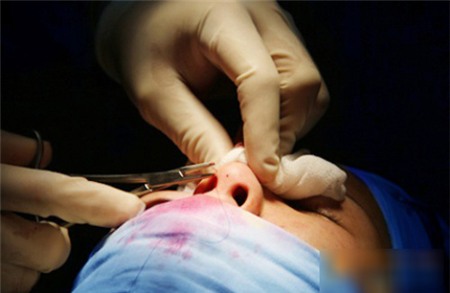 Nâng mũi silicone, sụn & tiêm - Đâu là phương pháp hoản hảo nhất 10