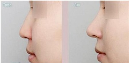  Nâng mũi silicone, sụn & tiêm - Đâu là phương pháp hoản hảo nhất 11