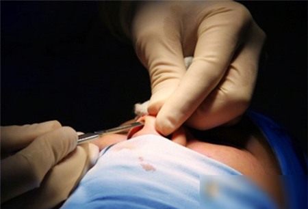 Nâng mũi silicone, sụn & tiêm - Đâu là phương pháp hoản hảo nhất 9