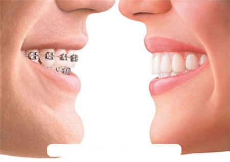 Niềng răng: lợi nhiều, hại cũng không ít 1