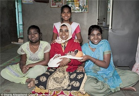 Bé gái sơ sinh mọc đầy lông như 