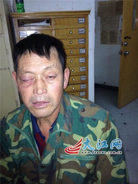 Hoảng hồn chai sữa chua uống phát nổ khiến mắt sưng vù 2