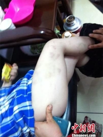 Bé 4 tuổi bị cô giáo mầm non đánh tím bầm khắp người 2